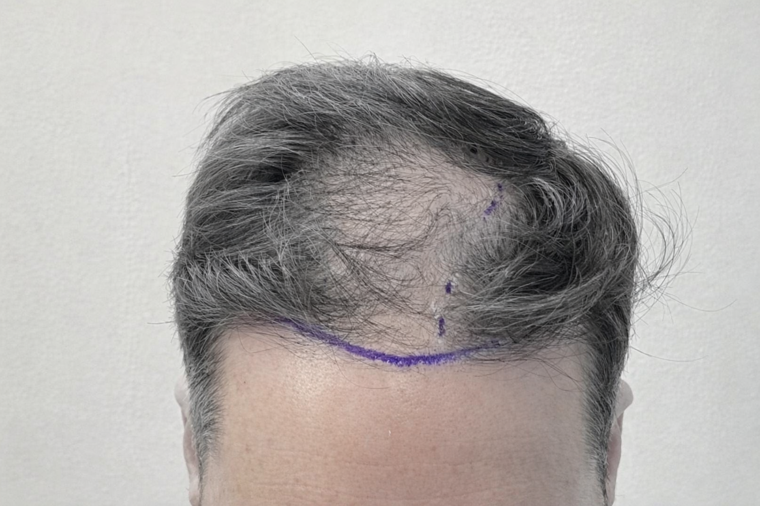 Πριν τη μεταμόσχευση